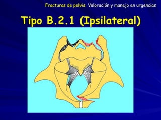 Tipo B.2.1 (Ipsilateral)
Fracturas de pelvis Valoración y manejo en urgencias
 