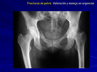 Fracturas de pelvis Valoración y manejo en urgencias
 