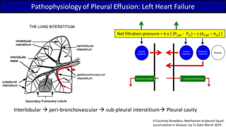 Parietal
Capillaries
Lymphatic (stomata)
Visceral
Capillaries
Lymphatic (No stomata)
Pulmonary
Capillaries Alveoli
Net filtration pressure = k x [ (PCAP – PIC) – s (PCAP – PIC) ]
Pathophysiology of Pleural Effusion: Left Heart Failure
Interlobular  peri-bronchovascular  sub-pleural interstitium Pleural cavity
V Courtney Broaddus: Mechanism of pleural liquid
accumulation in disease; Up To Date March 2019
Net filtration pressure = k x [ (PCAP - PIC) – s (πCAP – πIC) ]
 