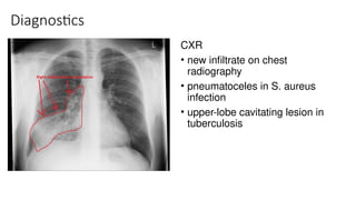 Diagnostics
CXR
• new infiltrate on chest
radiography
• pneumatoceles in S. aureus
infection
• upper-lobe cavitating lesion in
tuberculosis
 