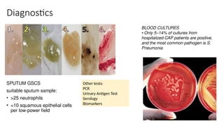 Diagnostics
SPUTUM GSCS
suitable sputum sample:
• >25 neutrophils
• <10 squamous epithelial cells
per low-power field
BLOOD CULTURES
• Only 5–14% of cultures from
hospitalized CAP patients are positive,
and the most common pathogen is S.
Pneumonia
Other tests:
PCR
Urinary Antigen Test
Serology
Biomarkers
 
