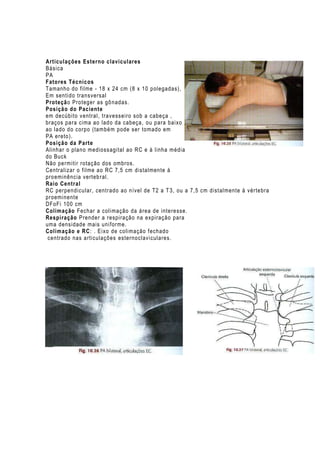 Articulações Esterno claviculares
Básica
PA
Fatores Técnicos
Tamanho do filme - 18 x 24 cm (8 x 10 polegadas),
Em sentido transversal
Proteção Proteger as gô nadas.
Posição do Paciente
em decúbito v entral , travesseiro sob a cabeça ,
braços para cima ao lado da cabeça, ou para baixo
ao lado do corpo (também pode ser tomado em
PA ereto).
Posição da Parte
Alinhar o plano medioss agital ao RC e à linha média
do Buck
Não permitir rotaç ão dos ombros.
Centralizar o filme ao RC 7,5 cm distalmente à
pro eminência verteb ral.
Raio Central
RC perpendicu lar, centrado ao nível de T2 a T 3, ou a 7,5 cm distalmente à vértebra
proeminente
DFoFi 100 cm
Colimação Fechar a coli mação da área de interesse.
Respiração Prender a respiração na expiração para
uma densidade mais uni forme.
Colimação e RC: . Eixo de colimação fechado
centrado nas articulações esternoclaviculares.

 
