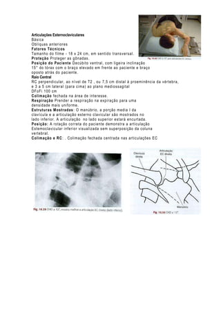 Articulações Esternoclaviculares
Básica
Oblíquas anteriores
Fatores Técnicos
Tamanho do filme - 18 x 24 cm , em sentido transversal .
Proteção Proteger as gônadas.
Posição do Paciente Decúbito ventral, com ligeira inclinação
15° do tórax com o braç o elevado em frente ao paciente e braço
oposto atrás do paciente.
Raio Central
RC perpendicular, ao nível de T2 , ou 7,5 cm distal à proeminência da vértebra,
e 3 a 5 cm lateral (para cima) ao plano mediossagital
DFoFi 100 cm
Colimação fechada na área de i nteresse.
Respiração Prender a respiração na expiração para uma
densidade mais uniforme.
Estruturas Mostradas : O manúbrio, a porção media I da
clavícula e a articul ação esterno clavicular são mostrados no
lado inferior. A articulaç ão no lado superior estará encurtada.
Posição: A rotação correta do paciente demonstra a articulação
Estemoclavicular inferior visualizada sem superposição da coluna
vertebral.
Colimação e RC: . Coli mação fechada centrada nas articulações EC

 