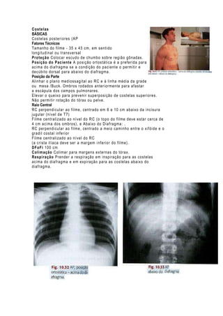 Costelas
BÁSICAS
Costelas posteri ores (AP
Fatores Técnicos
Tamanho do filme - 35 x 43 cm, em sentido
longitudinal ou transvers al
Proteção Coloc ar escudo de chumbo sobre região gônadas.
Posição do Paciente A posição ortostática é a preferida para
acima do diafragma s e a condição do paciente o permitir e
decúbito dorsal para abaixo do diafragma.
Posição da Parte
Alinhar o plano medioss agital ao RC e à linha média da grade
ou mesa /Buck. Ombros rodados anteriormente para afastar
a escápula dos campos pulmonares.
Elevar o queixo para prevenir superposição de costelas superiores.
Não permitir rotaç ão do tórax ou pelve.
Raio Central
RC perpendicular ao fil me, centrado em 8 a 10 cm abaixo da incisura
jugular (nível de T7)
Filme centralizado ao nível do R C (o topo do filme deve estar cerca de
4 cm acima dos ombros), e Abaixo do Diafragma: .
RC perpendicular ao fil me, centrado a meio caminho entre o xifóide e o
gradil costal inferior
Filme centralizado ao nível do RC
(a crista ilíaca deve ser a margem i nferior do filme).
DFoFi 100 cm
Colimação Colimar para margens externas do tórax.
Respiração Prender a respiração em inspiração para as costelas
acima do diafragma e em expiração para as costelas abaixo do
diafragma.

 