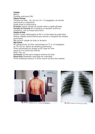 Costelas
Básica
Costelas anteri ores (PA)
Fatores Técnicos
Tamanho do filme - 35 x 43 cm (14 x 17 polegadas), em sentido
transversal ou longitudinal
Grade móvel ou estacionária
Proteção Coloc ar escudo de chumbo sobre a região gônadas.
Posição do Paciente Em ortostática ou decúbito ventral se
necessário, com os braç os para baixo.
Posição da Parte
Alinhar o plano mediosagital ao RC e à linha média da grade Buck.
Ombros rodados anteriormente para remover a escápula dos campos
pulmonares.
Não permitir rotaç ão do tórax ou da pelve.
Raio Central
RC perpendicular ao fil me, centralizado em T7 (7 a 8 polegadas,
ou 18 a 20 cm, abaixo da vértebra proeminente)
Filme centralizado em relação ao RC (topo do filme
cerca de 4 cm acima dos ombros)
DFoFi 100, cm
Colimação Colimar para margens externas do tórax.
Respiração Sus pender respiração em inspiração.
PA do arcabouço torácic o: A rotina comum na série das costelas

 