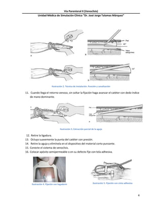 Vía Parenteral II (Venoclisis)
Unidad Médica de Simulación Clínica “Dr. José Jorge Talamas Márquez”
4
Ilustración 2. Técnica de instalación. Punción y canalización
11. Cuando llega el retorno venoso, sin soltar la fijación haga avanzar el catéter con dedo índice
de mano dominante.
Ilustración 3. Extracción parcial de la aguja
12. Retire la ligadura.
13. Ocluya suavemente la punta del catéter con presión.
14. Retire la aguja y elimínela en el dispositivo del material corto punzante.
15. Conecte el sistema de venoclisis.
16. Colocar apósito semipermeable o en su defecto fije con tela adhesiva.
Ilustración 4. Fijación con tegaderm Ilustración 5. Fijación con cinta adhesiva
 