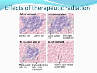 Effects of therapeutic radiation
 