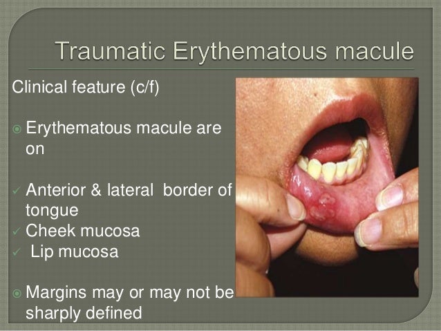 Red Lesion Of Oral Mucosa
