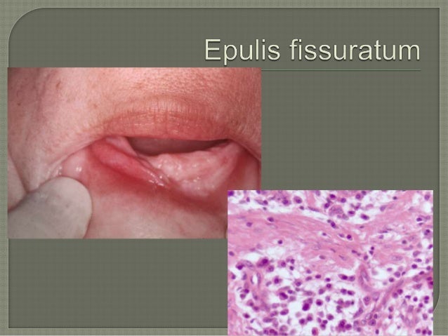 Red Lesion Of Oral Mucosa