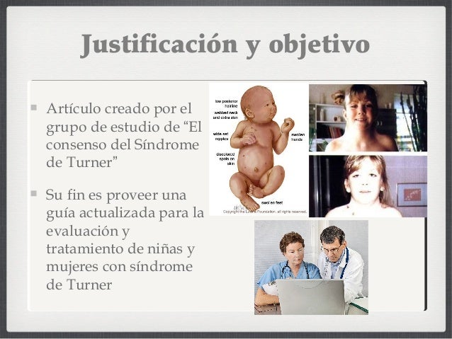 Sindrome de Turner