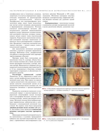 Э К С П Е Р И М Е Н Т А Л Ь Н А Я И К Л И Н И Ч Е С К А Я Д Е Р М А Т О К О С М Е Т О Л О Г И Я № 2 , 2 0 1 2 
61 
О Б М Е Н О П Ы Т О М 
липофиллингу или к технически сложным, 
затратным и не всегда оправданным хирур- 
гическим операциям по реконструкции 
женской аногенитальной области. 
Липофиллинг, или липотрансферинг ауто- 
логичного жира, имеет такие недостатки, 
как частые случаи миграции, рассасывания 
и формирования липогранулем. Поэтому 
считается непопулярным методом. Для 
оптимального решения вышеназванных 
проблем следует применять техники интим- 
ной контурной пластики, которые ознаме- 
новали начало нового этапа пластической 
хирургии. В результате выполнения интим- 
ной контурной пластики значительно со- 
кратится число разочарований и ограниче- 
ний. Внедрение в практику интимной кон- 
турной пластики – начало нового этапа в 
пластической хирургии. 
Для выполнения интимной контурной 
пластики у мужчин и женщин применяется 
препарат Bellcontour Gvisc, разработанный 
для работы в аногенитальной зоне (препарат 
зарегистрирован в России). 
Препарат может быть использован для 
увеличения точки G, клитора, объема боль- 
ших и малых половых губ, а также для увлаж- 
нения преддверия влагалища, клитора, ман- 
тии клитора. Выпускается в шприцах для од- 
нократного использования вместимостью 0,8 
и 1,0 мл, упакованных в блистеры, которые 
гарантируют сохранность и абсолютную сте- 
рильность средства. 
Рассмотрим клинический случай. 
Пациентка, 29 лет, обратилась в нашу кли- 
нику с целью профилактики возрастных из- 
менений кожи лица. При опросе на приеме 
у врача-косметолога она рассказала о сни- 
жении качества сексуальной жизни из-за 
увеличения размера малых половых губ, что 
пациентка связывала с предшествующими 
родами. 
Пациентку осмотрели гинеколог и пла- 
стический хирург и диагностировали вы- 
раженную гипертрофию малых половых 
губ и гипотрофию больших половых губ и 
головки клитора, зияние преддверия влага- 
лища. Методом лечения была выбрана кра- 
евая хирургическая лабиопластика в ком- 
бинации с инъекционной интимной пла- 
стикой. На первом этапе была выполнена 
линейная резекция малых половых губ (рис. 
5). На втором этапе проведена комплексная 
интимная контурная пластика препаратом 
Gvisc. 
Процедуры интимной контурной пласти- 
ки выполнялись в условиях процедурного 
кабинета под местной анестезией (без седа- 
ции) с применением анестезирующего геля 
местного действия Mesonumb и 10% спрея 
лидокаина. Интимная контурная пластика 
включала: клиторопластику, коррекцию объ- 
ема больших половых губ, удаление задней 
спайки. 
Клиторопластика – наполнение головки 
и капюшона клитора гиалуроновой кислотой 
в целях увеличения объема, «усиления» чув- 
а б 
а б 
а б 
Рис. 4. Результаты хирургической коррекции изменений женских наружных 
половых органов: а – исходное состояние; б – сразу после операции 
а б 
Рис. 5. Результаты линейной резекции малых половых губ: а – до операции; 
б – на 7-е сутки после операции 
 