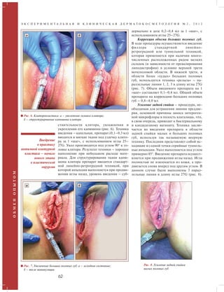 Э К С П Е Р И М Е Н Т А Л Ь Н А Я И К Л И Н И Ч Е С К А Я Д Е Р М А Т О К О С М Е Т О Л О Г И Я № 2 , 2 0 1 2 
а б 
ствительности клитора, увлажнения и 
укрепления его капюшона (рис. 6). Техника 
введения – капельная, препарат (0,1–0,3 мл) 
вводится в мягкие ткани под уздечку клито- 
ра за 1 «шаг», с использованием иглы 25– 
27G. Укол производится под углом 90° к го- 
ловке клитора. Результат техники – хорошее 
наполнение при небольшом расходе мате- 
риала. Для структурирования ткани капю- 
шона клитора препарат вводится стандарт- 
ной линейно-ретроградной техникой, при 
которой инъекция выполняется при продви- 
жении иглы назад, уровень введения – суб- 
Внедрение 
в практику 
интимной контурной 
пластики – начало 
нового этапа 
в пластической 
хирургии 
62 О Б М Е Н О П Ы Т О М 
дермально в дозе 0,2–0,4 мл за 1 «шаг», с 
использованием иглы 25–27G. 
Коррекция объема больших половых губ. 
В ходе процедуры осуществляется введение 
филлера стандартной линейно- 
ретроградной или туннельной техникой, 
которая применяется при наличии много- 
численных расположенных рядом мелких 
складок (в зависимости от превалирования 
липодистрофии) в условно верхней трети 
мочеполовой области. В нижней трети, в 
области более «худых» больших половых 
губ, используется техника «рельсы» – па- 
раллельные линии 1, 2, 3 в длину иглы 27G 
(рис. 7). Объем вводимого препарата на 1 
«шаг» составляет 0,1–0,4 мл. Общий объем 
препарата на коррекцию больших половых 
губ – 0,8–4,0 мл. 
Усиление задней спайки – процедура, не- 
обходимая для устранения зияния преддве- 
рия, основной причины заноса энтероген- 
ной микрофлоры в полость влагалища, что, 
в свою очередь, приводит к бактериальному 
и кандидозному вагиниту. Техника заклю- 
чается во введении препарата в области 
задней спайки малых и больших половых 
губ, используя так называемую веерную 
технику. Последняя представляет собой ис- 
ходящие из одной точки серийные туннель- 
ные инъекции. Укол выполняется под углом 
примерно 45°. Введение препарата осущест- 
вляется при продвижении иглы назад. Игла 
полностью не извлекается из кожи, а про- 
двигается снова вперед под другим углом. В 
данном случае были выполнены 3 парал- 
лельные линии в длину иглы 27G (рис. 8). 
Рис. 6. Клиторопластика: а – увеличение головки клитора; 
б – структурирование капюшона клитора 
а б 
Рис. 7. Увеличение больших половых губ: а – исходное состояние; 
б – после манипуляции 
Рис. 8. Усиление задней спайки 
малых половых губ 
 