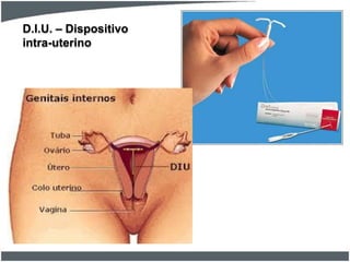 D.I.U. – Dispositivo
intra-uterino

 