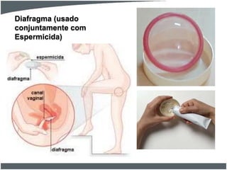 Diafragma (usado
conjuntamente com
Espermicida)

 