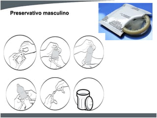 Preservativo masculino

 