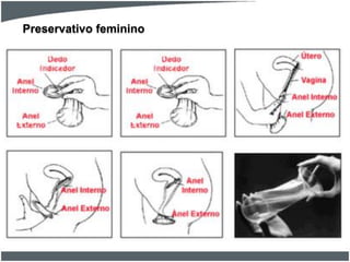 Preservativo feminino

 