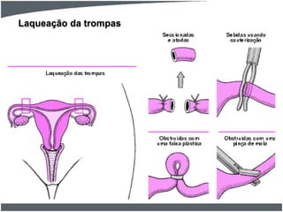 Laqueação da trompas

 