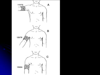 Los efectos de las
variables de
posición de los
brazos sobre la
presión arterial
registrados en la
arteria braquial.
 