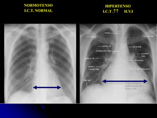 NORMOTENSO
I.C.T. NORMAL
HIPERTENSO
I.C.T . H.V.I
 
