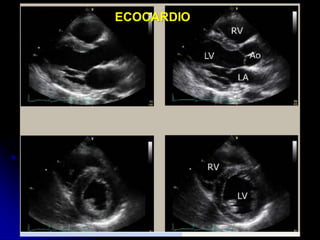 ECOCARDIO
 