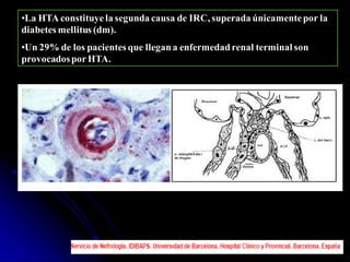 •La HTA constituyela segunda causa de IRC, superada únicamentepor la
diabetes mellitus (dm).
•Un 29% de los pacientes que llegana enfermedadrenal terminal son
provocadosporHTA.
 