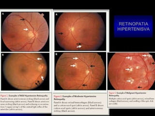 RETINOPATIA
HIPERTENISVA
 