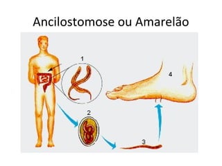 Ancilostomose ou Amarelão
 