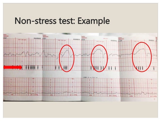 Antepartum fetal testing