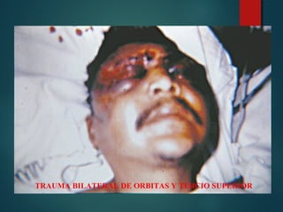 TRAUMA BILATERAL DE ORBITAS Y TERCIO SUPERIOR
 