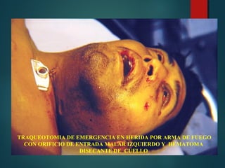 TRAQUEOTOMIA DE EMERGENCIA EN HERIDA POR ARMA DE FUEGO
CON ORIFICIO DE ENTRADA MALAR IZQUIERDO Y HEMATOMA
DISECANTE DE CUELLO
 