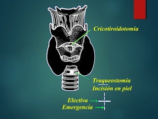 Cricotiroidotomia
Traqueostomia
Incisión en piel
Electiva
Emergencia
 