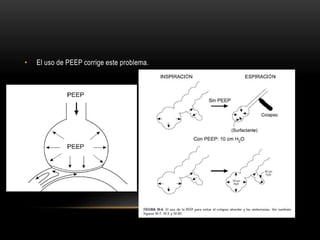• El uso de PEEP corrige este problema.
 