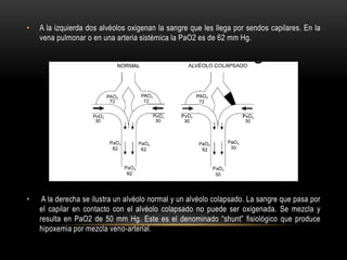 • A la izquierda dos alvéolos oxigenan la sangre que les llega por sendos capilares. En la
vena pulmonar o en una arteria sistémica la PaO2 es de 62 mm Hg.
• A la derecha se ilustra un alvéolo normal y un alvéolo colapsado. La sangre que pasa por
el capilar en contacto con el alvéolo colapsado no puede ser oxigenada. Se mezcla y
resulta en PaO2 de 50 mm Hg. Este es el denominado “shunt” fisiológico que produce
hipoxemia por mezcla veno-arterial.
 