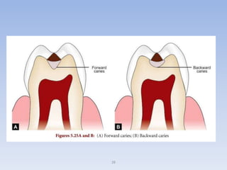 02.dental caries | PPTX