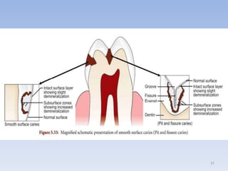 02.dental caries | PPTX