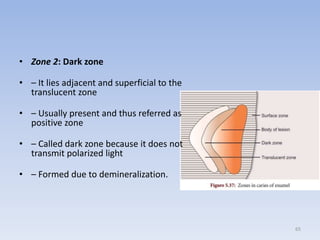 02.dental caries | PPTX