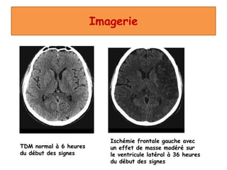 Imagerie
TDM normal à 6 heures
du début des signes
Ischémie frontale gauche avec
un effet de masse modéré sur
le ventricule latéral à 36 heures
du début des signes
 