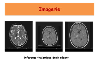 Imagerie
infarctus thalamique droit récent
 