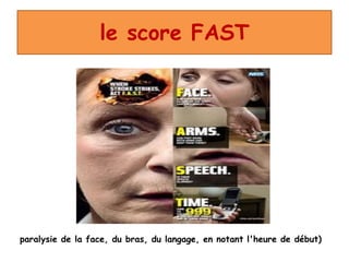 le score FAST
paralysie de la face, du bras, du langage, en notant l'heure de début)
 