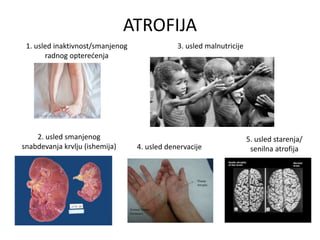 ATROFIJA
1. usled inaktivnost/smanjenog
radnog opterećenja
2. usled smanjenog
snabdevanja krvlju (ishemija) 4. usled denervacije
3. usled malnutricije
5. usled starenja/
senilna atrofija
 