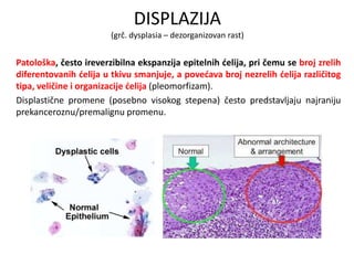 DISPLAZIJA
(grč. dysplasia – dezorganizovan rast)
Patološka, često ireverzibilna ekspanzija epitelnih ćelija, pri čemu se broj zrelih
diferentovanih ćelija u tkivu smanjuje, a povećava broj nezrelih ćelija različitog
tipa, veličine i organizacije ćelija (pleomorfizam).
Displastične promene (posebno visokog stepena) često predstavljaju najraniju
prekanceroznu/premalignu promenu.
 