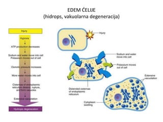 EDEM ĆELIJE
(hidrops, vakuolarna degeneracija)
 
