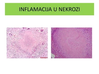 INFLAMACIJA U NEKROZI
 