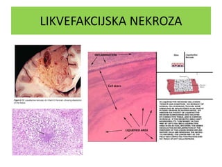 LIKVEFAKCIJSKA NEKROZA
 