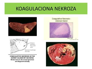 KOAGULACIONA NEKROZA
 