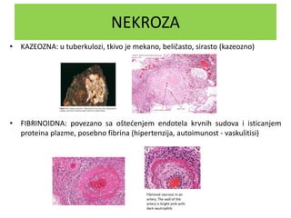NEKROZA
• KAZEOZNA: u tuberkulozi, tkivo je mekano, beličasto, sirasto (kazeozno)
• FIBRINOIDNA: povezano sa oštećenjem endotela krvnih sudova i isticanjem
proteina plazme, posebno fibrina (hipertenzija, autoimunost - vaskulitisi)
 