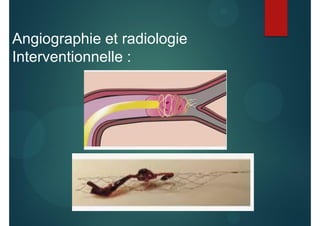Angiographie et radiologie
Interventionnelle :
 