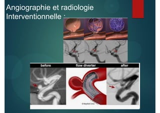 Angiographie et radiologie
Interventionnelle :
 