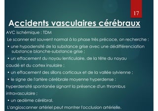Accidents vasculaires cérébraux
AVC ischémique : TDM
Le scanner est souvent normal à la phase très précoce, on recherche :
• une hypodensité de la substance grise avec une dédifférenciation
substance blanche-substance grise ;
• un effacement du noyau lenticulaire, de la tête du noyau
caudé et du cortex insulaire ;
• un effacement des sillons corticaux et de la vallée sylvienne ;
• le signe de l'artère cérébrale moyenne hyperdense :
hyperdensité spontanée signant la présence d'un thrombus
intravasculaire ;
• un œdème cérébral.
L'angioscanner artériel peut montrer l'occlusion artérielle.
17
 