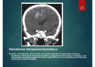 Hématome intraparenchymateux.
Scanner : reconstruction dans le plan coronal sans injection de produit de contraste,
montrant un hématome intraparenchymateux (saignement intra-axial) ( rectangle ), une
hémorragie méningée (saignement extra-axial) ( flèche ) et un hématome sous-dural de
la faux du cerveau ( triangle )
23
 